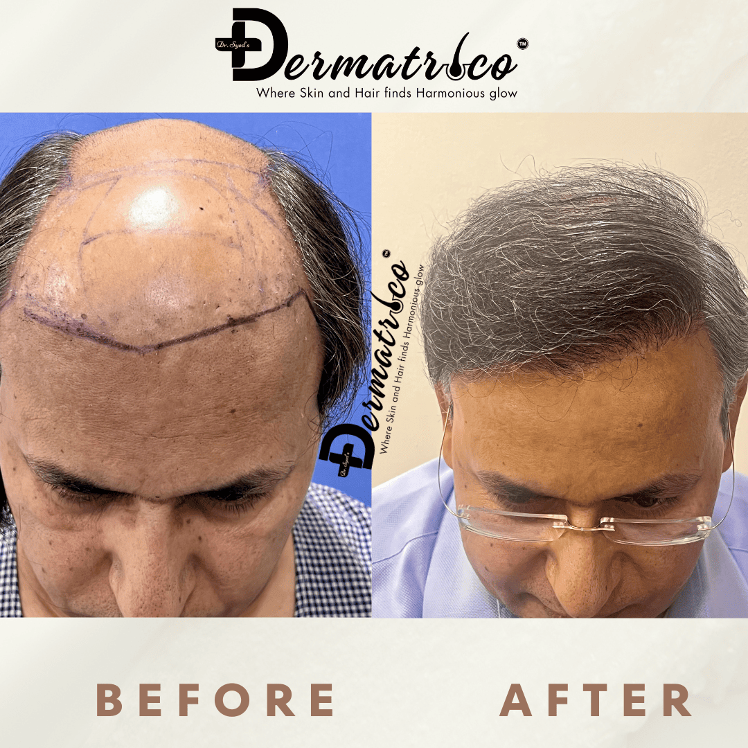 Hair Transplant Result